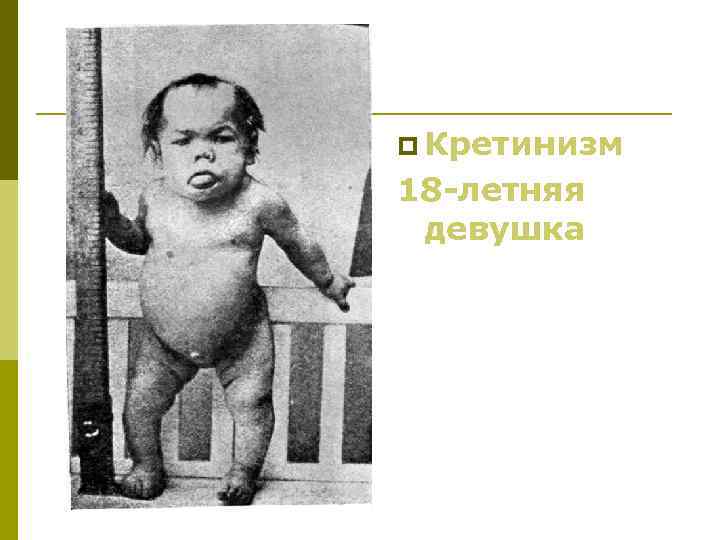 p Кретинизм 18 -летняя девушка 