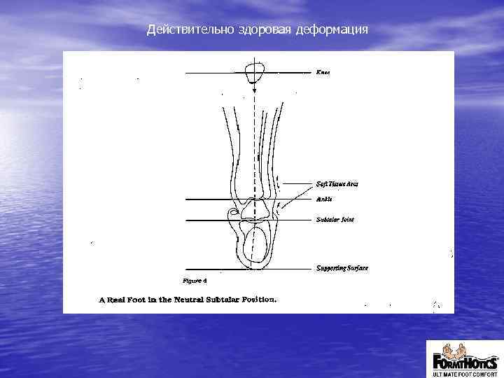 Действительно здоровая деформация 