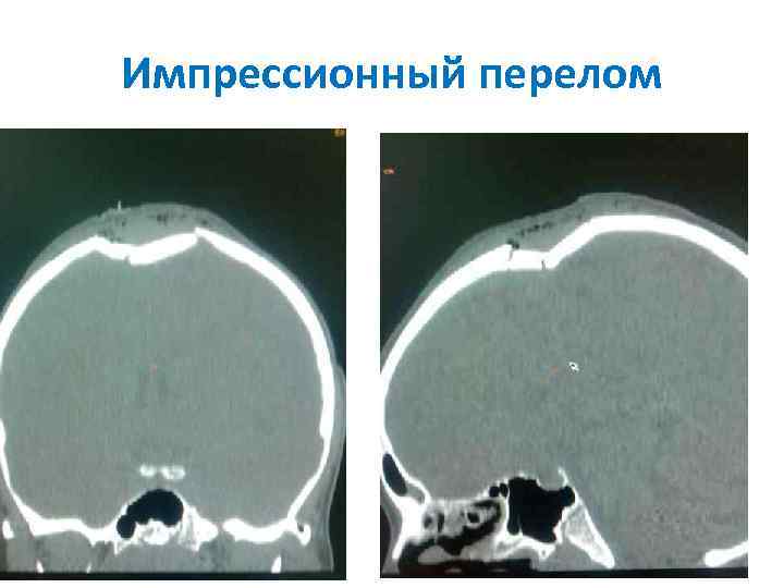 Импрессионный перелом 