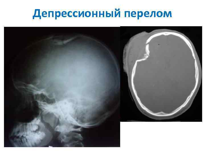 Депрессионный перелом 