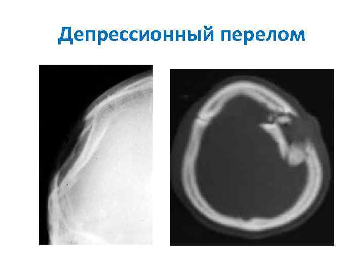 Депрессионный перелом 