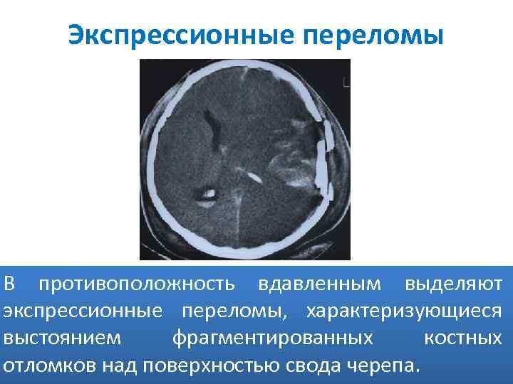 Экспрессионные переломы В противоположность вдавленным выделяют экспрессионные переломы, характеризующиеся выстоянием фрагментированных костных отломков над