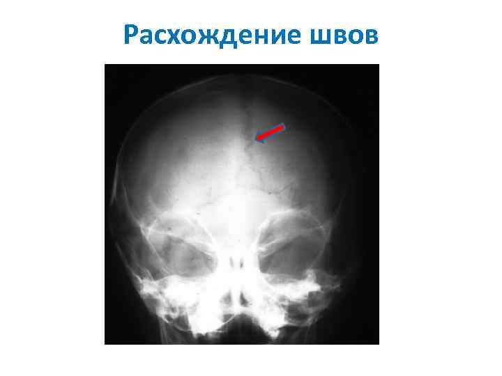 Расхождение швов 