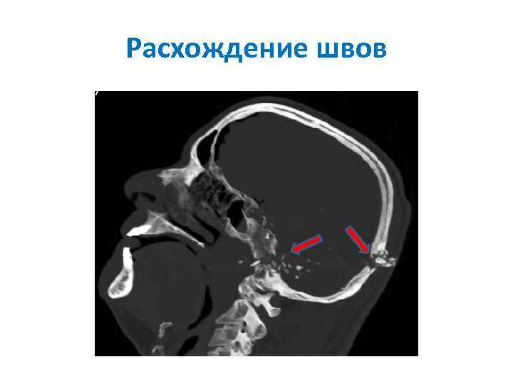 Расхождение швов 