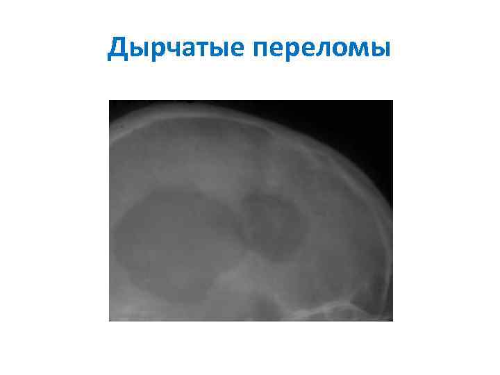 Дырчатые переломы 