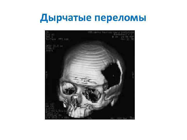 Дырчатые переломы 