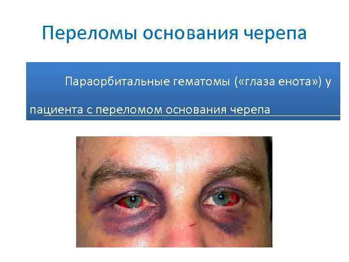 Переломы основания черепа Параорбитальные гематомы ( «глаза енота» ) у пациента с переломом основания