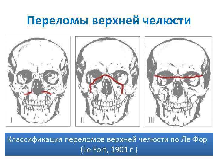 Переломы верхней челюсти Классификация переломов верхней челюсти по Ле Фор (Le Fort, 1901 г.
