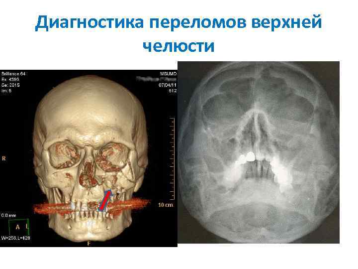 Диагностика переломов верхней челюсти 