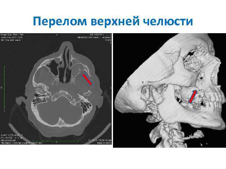 Перелом верхней челюсти 