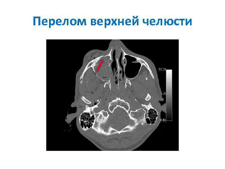 Перелом верхней челюсти 