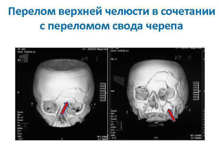 Перелом верхней челюсти в сочетании с переломом свода черепа 