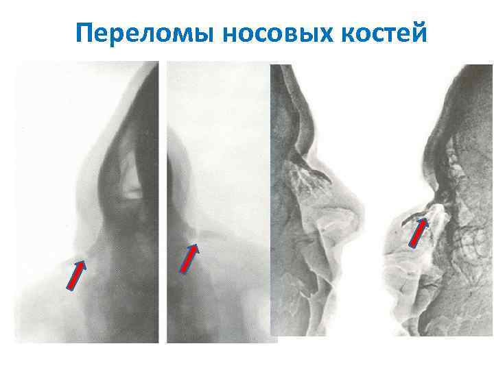Переломы носовых костей 