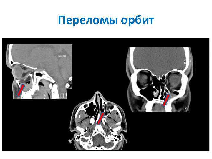 Переломы орбит 