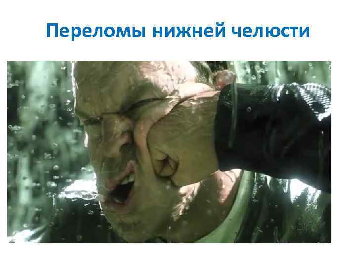 Переломы нижней челюсти 