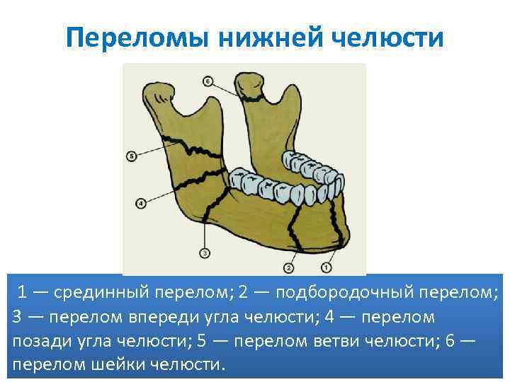 Переломы нижней челюсти 1 — срединный перелом; 2 — подбородочный перелом; 3 — перелом