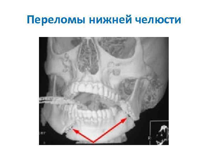 Переломы нижней челюсти 