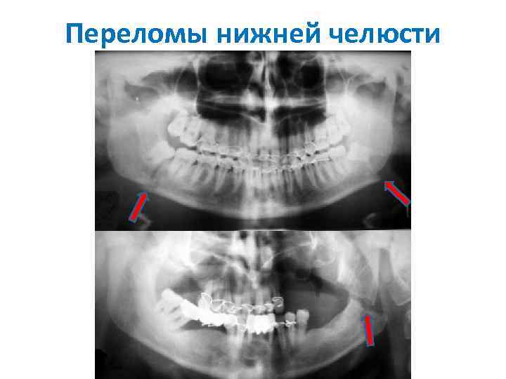 Переломы нижней челюсти 