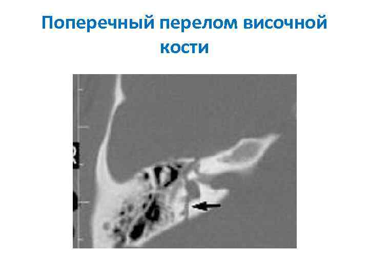 Поперечный перелом височной кости 