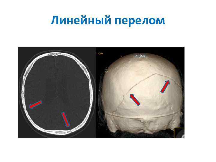 Перелом кости свода черепа