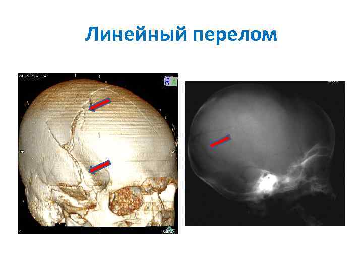 Линейный перелом 