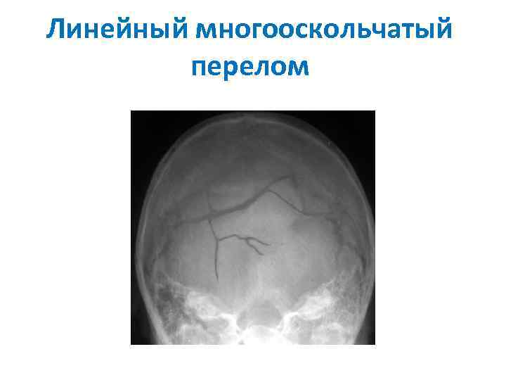 Линейная трещина. Линейный перелом костей свода черепа. Паутинообразный перелом черепа. Краниография линейный перелом теменной кости. Многооскольчатый перелом черепа.