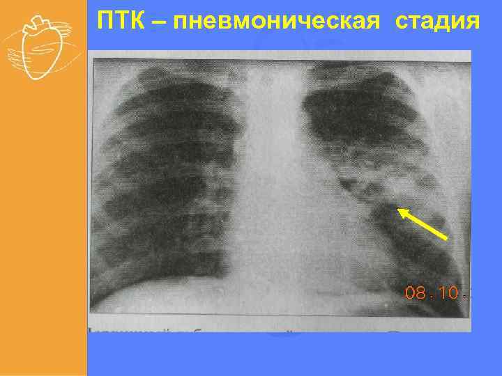 ПТК – пневмоническая стадия 