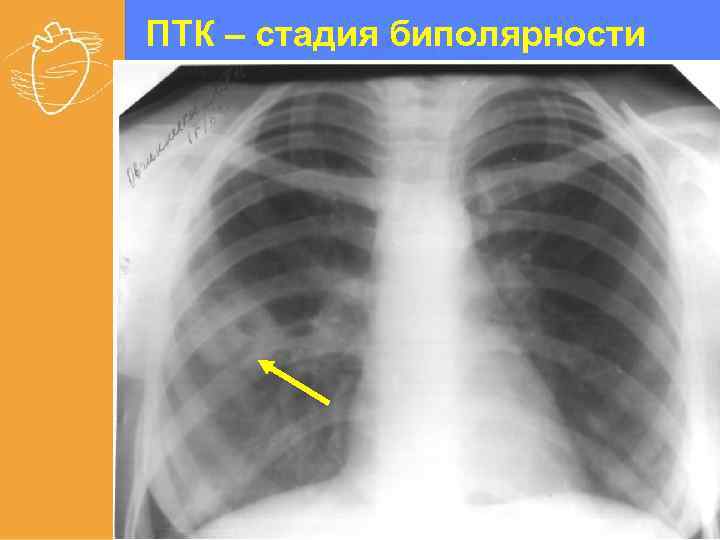 Распад туберкулезного инфильтрата сформировавшегося в стенке бронха приводит к появлению