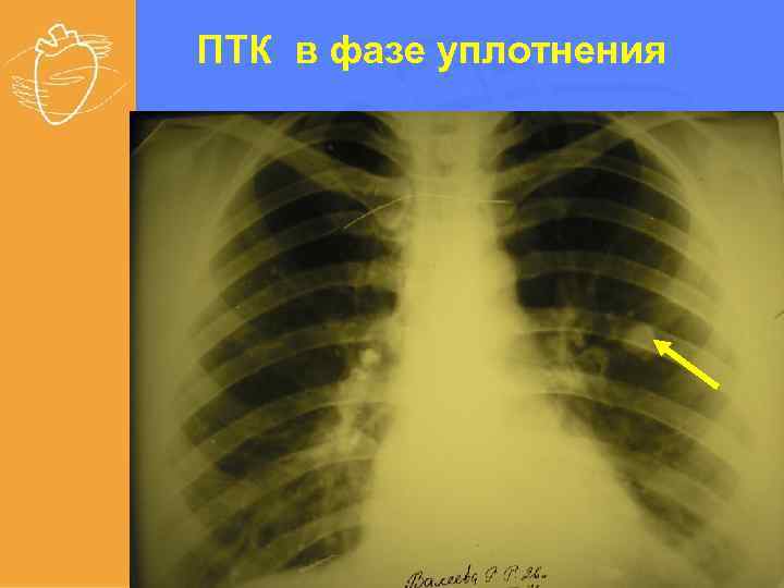 ПТК в фазе уплотнения 