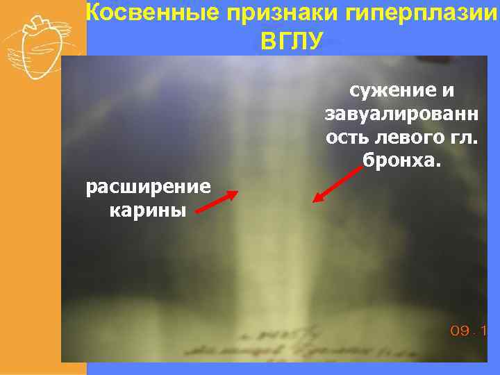 Косвенные признаки гиперплазии ВГЛУ , сужение и завуалированн ость левого гл. бронха. расширение карины