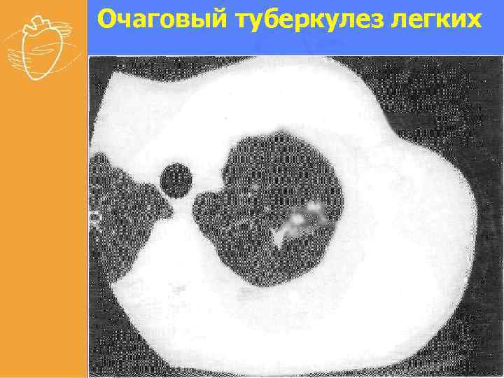 Очаговый туберкулез легких 