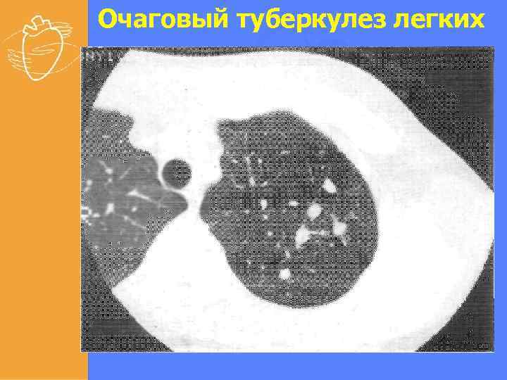 Очаговый туберкулез легких 