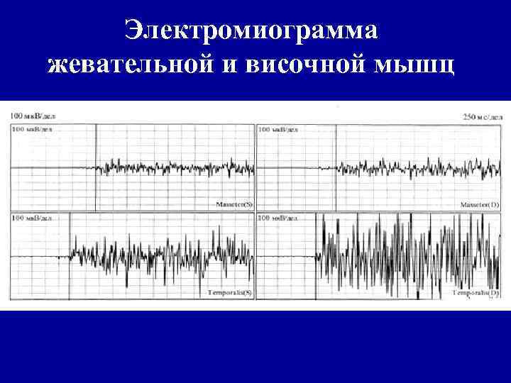 Электромиограмма жевательной и височной мышц 