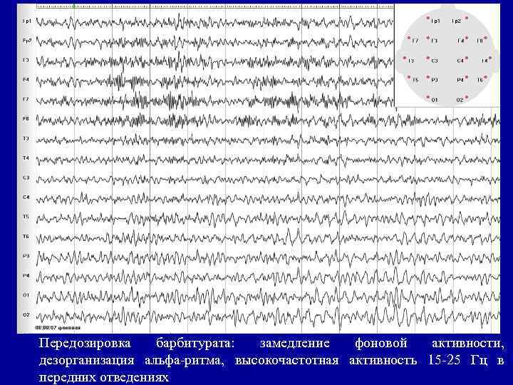 Передозировка барбитурата: замедление фоновой активности, дезорганизация альфа-ритма, высокочастотная активность 15 -25 Гц в передних