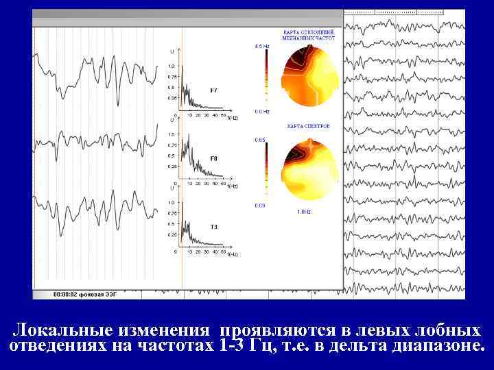 Локальные изменения проявляются в левых лобных отведениях на частотах 1 -3 Гц, т. е.