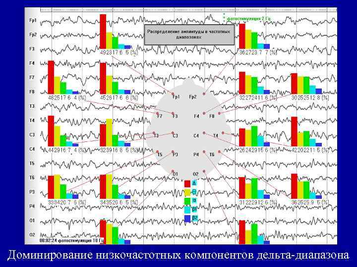 Доминирование низкочастотных компонентов дельта-диапазона 