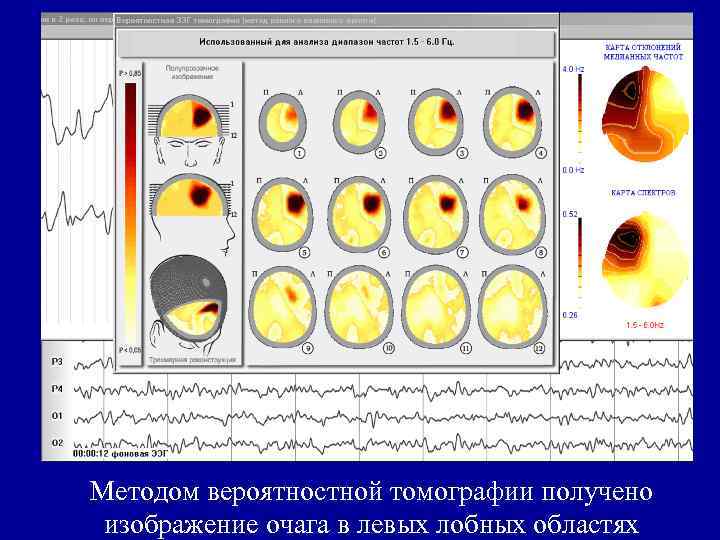 Методом вероятностной томографии получено изображение очага в левых лобных областях 