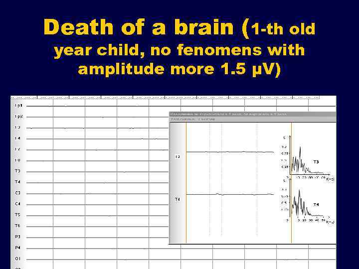 Death of a brain (1 -th old year child, no fenomens with amplitude more