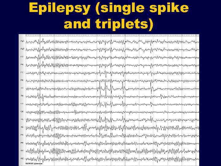 Epilepsy (single spike and triplets) 