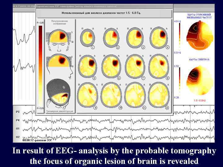 In result of EEG- analysis by the probable tomography the focus of organic lesion
