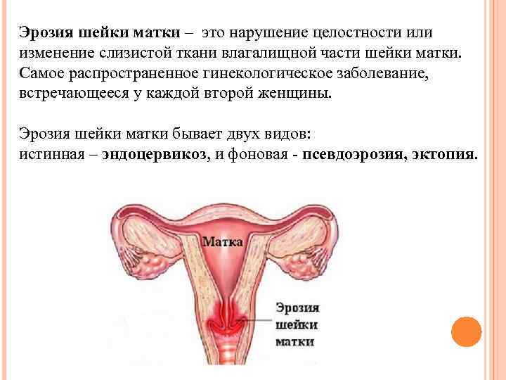 Эрозия шейки матки – это нарушение целостности или изменение слизистой ткани влагалищной части шейки
