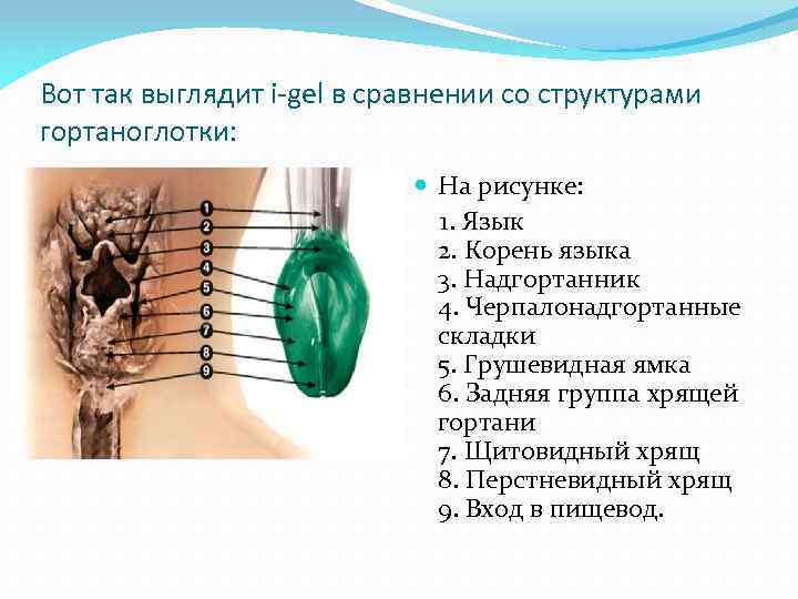 Вот так выглядит i-gel в сравнении со структурами гортаноглотки: На рисунке: 1. Язык 2.