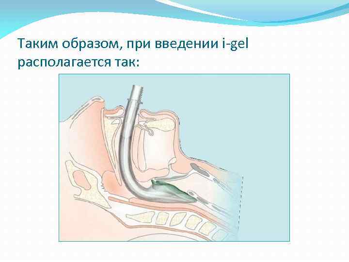 Таким образом, при введении i-gel располагается так: 