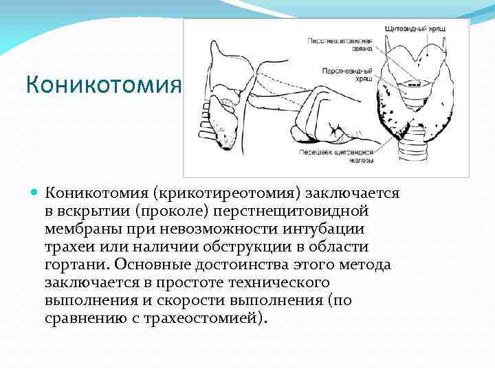 Коникотомия (крикотиреотомия) заключается в вскрытии (проколе) перстнещитовидной мембраны при невозможности интубации трахеи или наличии