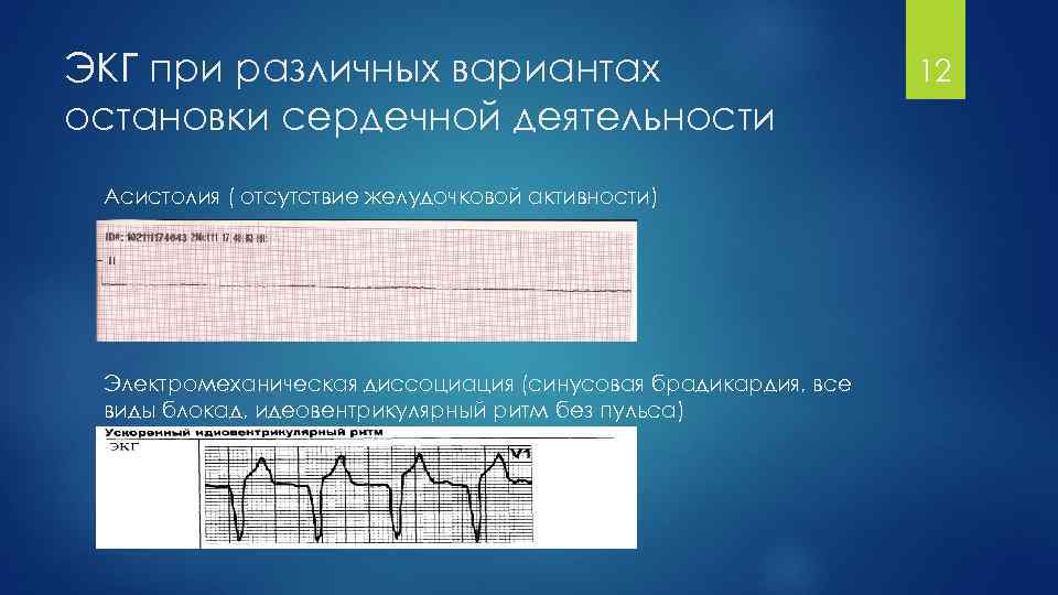 Признаки электромеханической диссоциации