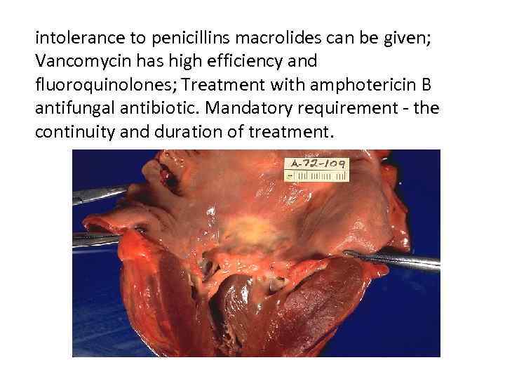 intolerance to penicillins macrolides can be given; Vancomycin has high efficiency and fluoroquinolones; Treatment