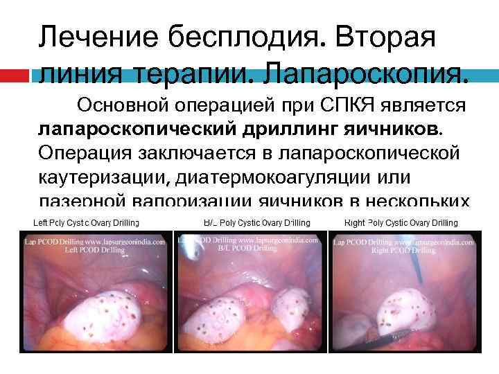 Лечение бесплодия. Вторая линия терапии. Лапароскопия. Основной операцией при СПКЯ является лапароскопический дриллинг яичников.