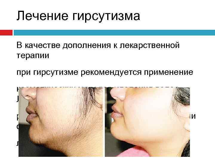 Лечение гирсутизма В качестве дополнения к лекарственной терапии при гирсутизме рекомендуется применение косметических методов