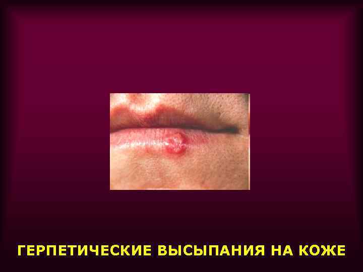 ГЕРПЕТИЧЕСКИЕ ВЫСЫПАНИЯ НА КОЖЕ 
