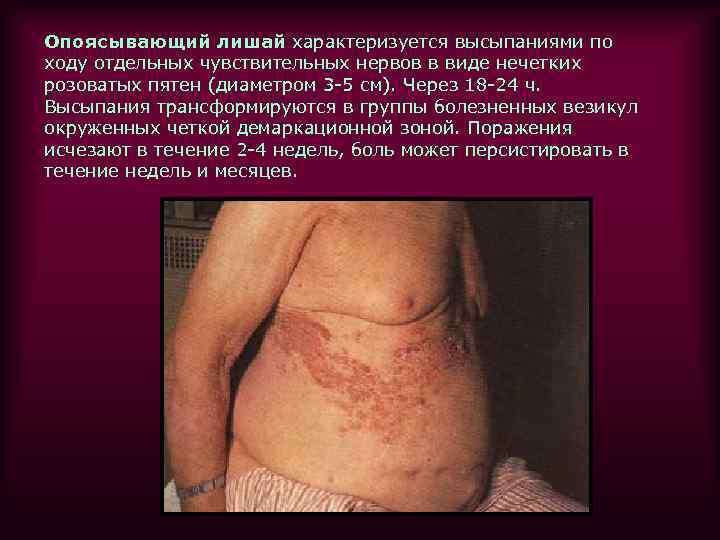 Опоясывающий лишай характеризуется высыпаниями по ходу отдельных чувствительных нервов в виде нечетких розоватых пятен